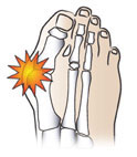 bunions