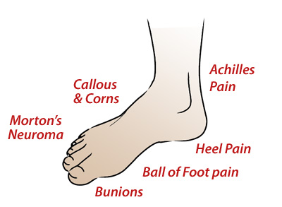 achilles pain, ball of foot pain, bunions, heel pain, callous & corns