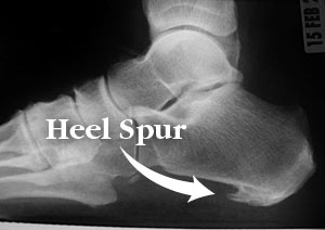 heel spur
