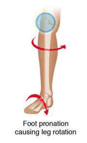 foot pronation causing knee pain