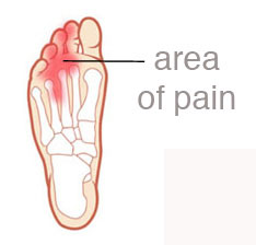 morton's neuroma treatment