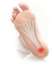 plantar fasciitis - planter fascitis